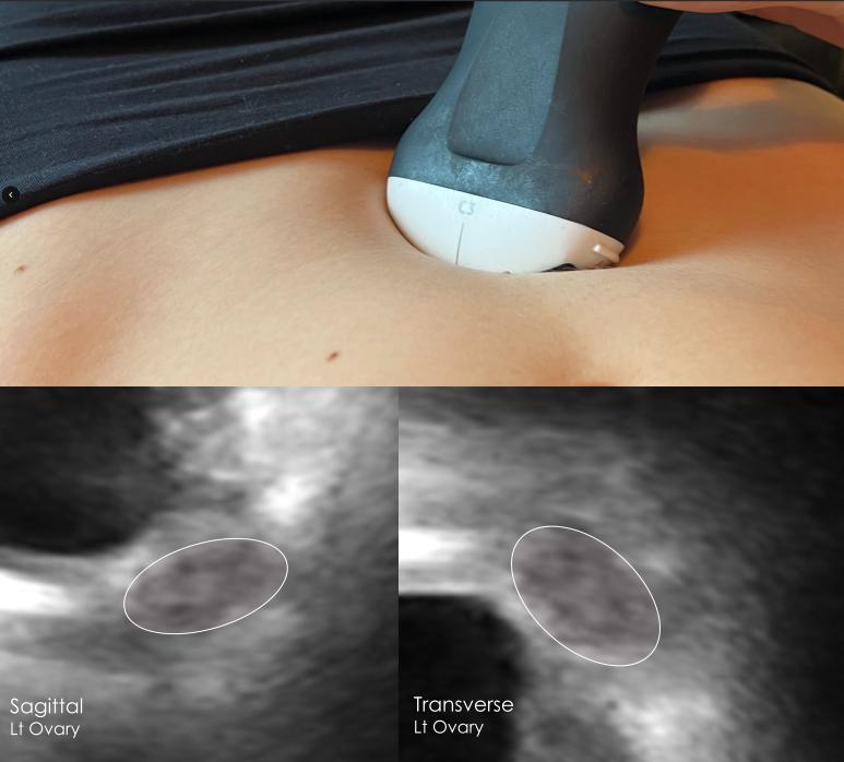 Ovarian imaging - sagittal and transverse views